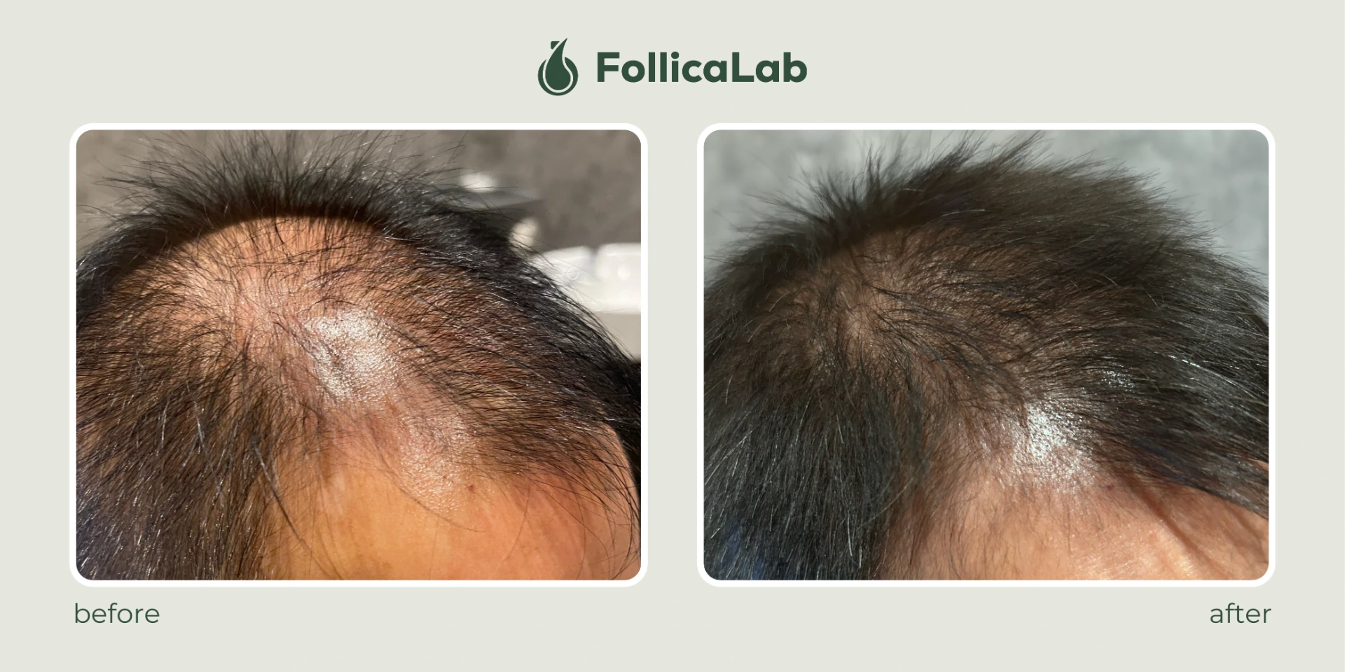Follica Lab Customer Testimony 2