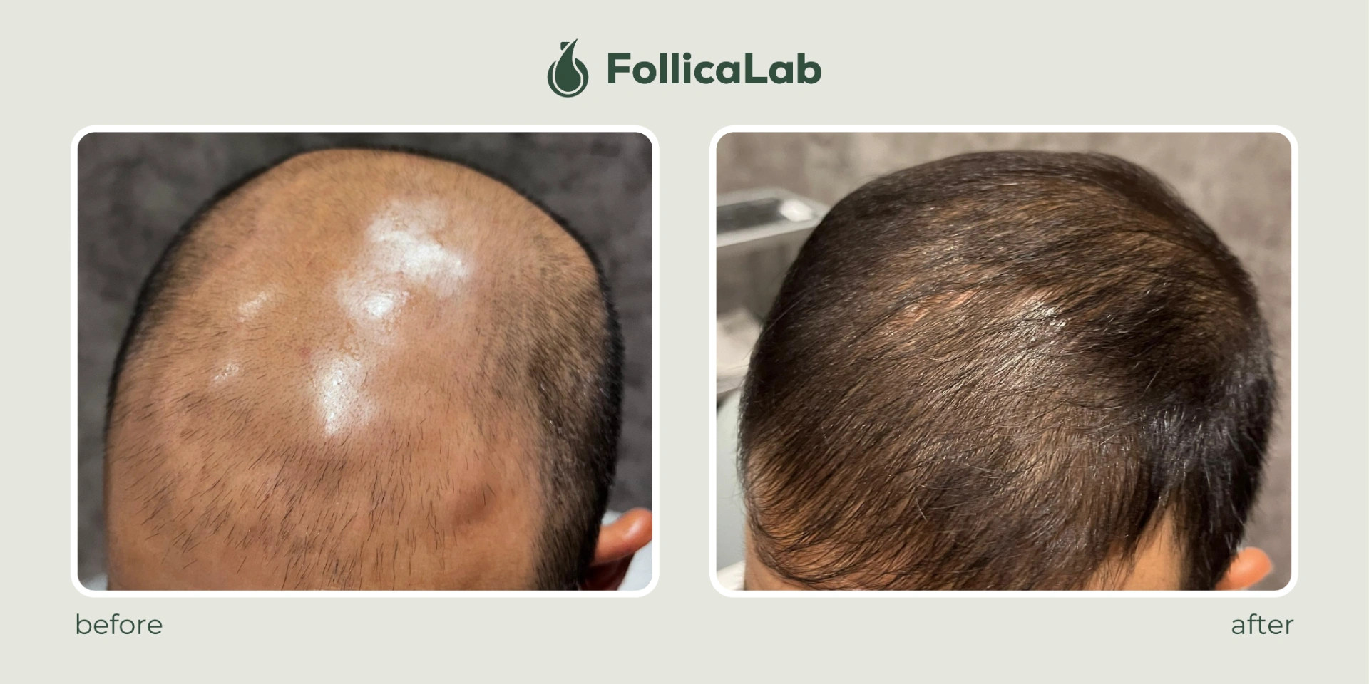 Follica Lab Customer Testimony 4