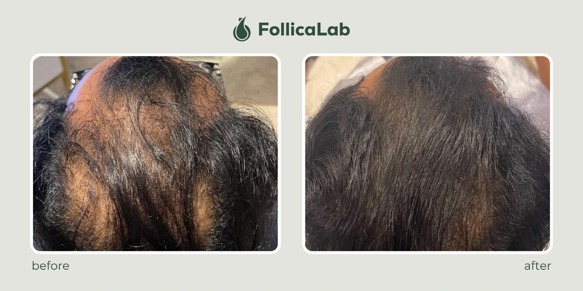 Follica Lab Customer Testimony 6